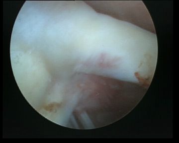 Arthroscopy Normal Biceps Insertion